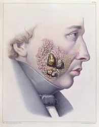 Die Gesichtssymptome der Geschlechtskrankheit, aus Traité Complet des Maladies Vénériennes von Philippe Ricord (1800-89) 1851