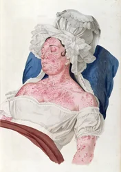 Frau mit Scharlach, aus einem Buch von Baron Jean Louis Alibert (1768-1837) graviert von Choupard, 1833