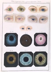 Beschreibung angeborener Augenanomalien, aus Klinische Darstellungen der Krankheiten und Bildungsfehler des menschlichen Auges, von Friedrich August von Ammon (1799-1861) 1838