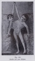 Giacomo und Giovanni Battista Tocci, italienische siamesische Zwillinge (s/w Foto)