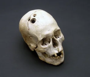 Trepanierter Schädel aus der Bronzezeit, Jericho, Palästina, 2200-2000 v. Chr.