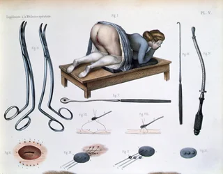 Eine Operation an einer vesikovaginalen Fistel, Tafel aus 