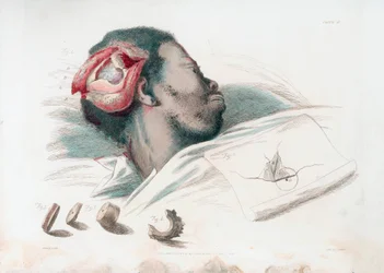 Ansicht einer Schädelwunde nach Trepanation und Entfernung des zersplitterten Knochenstücks unten links, 1821