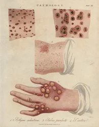Hautgeschwür, eitrige Krätze und Krätze verursacht durch eine Sarcoptes scabiei Milbe - Lithographie von John Pass, veröffentlicht in „Encyclopedia Londinensis“ von John Wilkes, J.Adlard Ausgabe, London