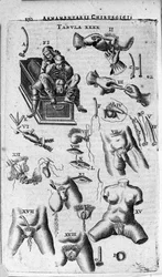 Chirurgische Eingriffe an den weiblichen und männlichen Geschlechtern. Gravur in „Armamentarium Surgical“ von J. Scultetus, Venedig