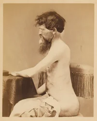 Private John Bar, Genesung nach einer Durchdringenden Bauchverletzung mit Bruch des Linken Os Innominatum, aus dem Fotografischen Katalog der Chirurgischen Abteilung